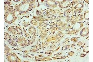 Immunohistochemistry of paraffin-embedded human breast cancer using ABIN7171432 at dilution of 1:100 (CCT6A 抗体  (AA 80-250))