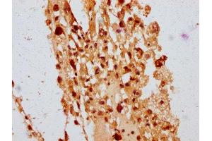 IHC image of ABIN7150243 diluted at 1:400 and staining in paraffin-embedded human melanoma performed on a Leica BondTM system. (POLE4 抗体  (AA 8-117))