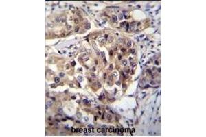hCG_1995004 Antibody (Center) (ABIN655542 and ABIN2850483) immunohistochemistry analysis in formalin fixed and paraffin embedded human breast carcinoma followed by peroxidase conjugation of the secondary antibody and DAB staining. (hCG_1995004 (AA 116-144) 抗体)