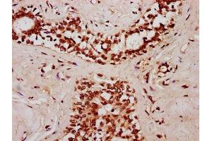 IHC image of ABIN7170858 diluted at 1:400 and staining in paraffin-embedded human breast cancer performed on a Leica BondTM system.