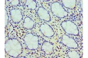 Immunohistochemistry of paraffin-embedded human colon cancer using ABIN7147595 at dilution of 1:100 (Cholecystokinin 抗体  (AA 21-115))