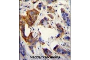 UBFD1 antibody (N-term) (ABIN655026 and ABIN2844657) immunohistochemistry analysis in formalin fixed and paraffin embedded human bladder carcinoma followed by peroxidase conjugation of the secondary antibody and DAB staining. (UBFD1 抗体  (N-Term))