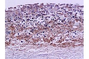 Formalin-fixed and paraffin embedded rat ovary carcinoma labeled with Anti-MMP-9 Polyclonal Antibody, Unconjugated (ABIN668095) at 1:200, followed by conjugation to the secondary antibody and DAB staining