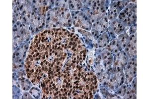 Immunohistochemical staining of paraffin-embedded Adenocarcinoma of colon tissue using anti-SRR mouse monoclonal antibody. (SRR 抗体)