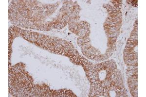 IHC-P Image Immunohistochemical analysis of paraffin-embedded human colon carcinoma, using PNPase, antibody at 1:250 dilution. (PNPT1 抗体  (N-Term))