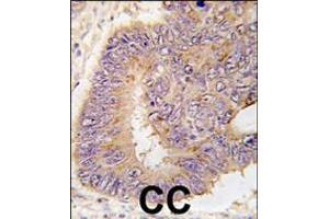 Formalin-fixed and paraffin-embedded human colon carcinoma tissue reacted with PDE8A antibody (L572), which was peroxidase-conjugated to the secondary antibody, followed by DAB staining. (PDE8A 抗体  (AA 557-587))