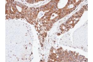 IHC-P Image Immunohistochemical analysis of paraffin-embedded human endo mitral ovarian cancer, using ERLIN2, antibody at 1:100 dilution. (ERLIN2 抗体  (C-Term))