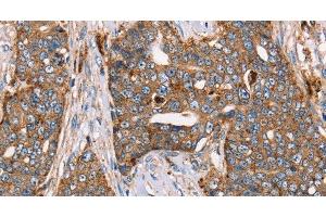 Immunohistochemistry of paraffin-embedded Human cervical cancer using FUCA1 Polyclonal Antibody at dilution of 1:30 (FUCA1 抗体)