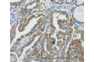 Immunohistochemistry of Human thyroid cancer using NPAP1 Polyclonal Antibody at dilution of 1:70 (NPAP1 抗体)