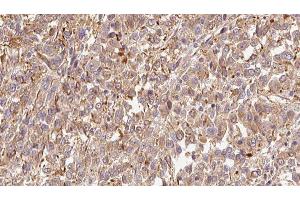 ABIN6279338 at 1/100 staining Human Melanoma tissue by IHC-P. (CST6 抗体  (N-Term))