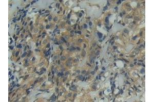 Detection of ITGaD in Human Breast cancer Tissue using Polyclonal Antibody to Integrin Alpha D (ITGaD)