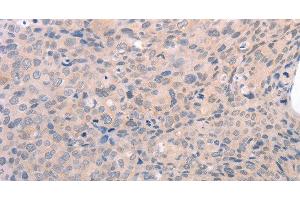 Immunohistochemistry of paraffin-embedded Human cervical cancer using EDG3 Polyclonal Antibody at dilution of 1:30 (S1PR3 抗体)