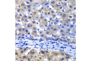 Immunohistochemistry of paraffin-embedded human liver injury using PSMD8 antibody at dilution of 1:100 (x40 lens). (PSMD8 抗体)