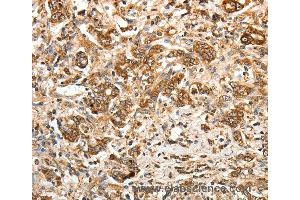 Immunohistochemistry of Human gastric cancer using CALR Polyclonal Antibody at dilution of 1:30 (Calreticulin 抗体)