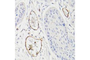 Immunohistochemistry of paraffin-embedded human esophageal cancer using CD34 Rabbit pAb (ABIN6134661, ABIN6138169, ABIN6138171 and ABIN6218103) at dilution of 1:100 (40x lens). (CD34 抗体  (C-Term))