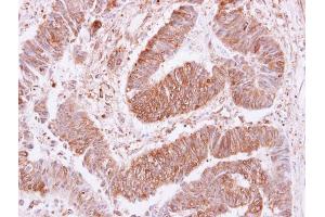 IHC-P Image VPS35 antibody [C3], C-term detects VPS35 protein at cytoplasm and membrane on human colon carcinoma by immunohistochemical analysis. (VPS35 抗体  (C-Term))