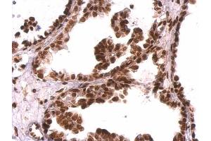 IHC-P Image GRB2 antibody detects GRB2 protein at nucleus on human ovarian carcinoma by immunohistochemical analysis.