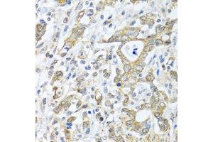 Immunohistochemistry of paraffin-embedded human gastric cancer using TICAM1 antibody. (TICAM1 抗体  (AA 20-200))