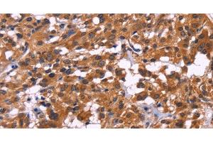 Immunohistochemistry of paraffin-embedded Human thyroid cancer tissue using MSH4 Polyclonal Antibody at dilution 1:30 (MSH4 抗体)
