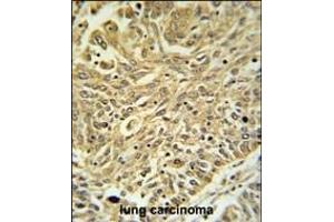 GSTK1 Antibody (Center) (ABIN653824 and ABIN2843092) IHC analysis in formalin fixed and paraffin embedded lung carcinoma followed by peroxidase conjugation of the secondary antibody and DAB staining. (GSTK1 抗体  (AA 93-120))