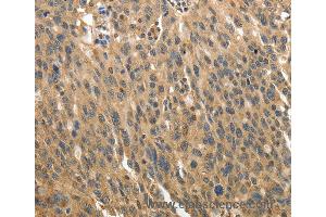 Immunohistochemistry of Human ovarian cancer using MSN Polyclonal Antibody at dilution of 1:30 (Moesin 抗体)