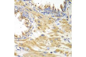 Immunohistochemistry of paraffin-embedded human prostate using PICK1 antibody at dilution of 1:100 (x40 lens).