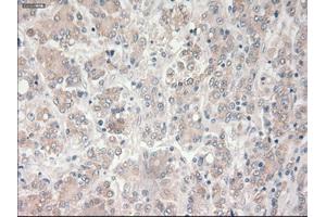 Immunohistochemical staining of paraffin-embedded Carcinoma of liver tissue using anti-PROM2mouse monoclonal antibody. (Prominin 2 抗体)