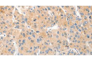 Immunohistochemistry of paraffin-embedded Human liver cancer using RPN1 Polyclonal Antibody at dilution of 1:30 (RPN1 抗体)