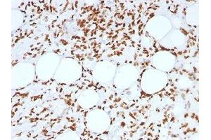 FFPE human angiosarcoma tested with Histone antibody (AE-4) (Histone 抗体)