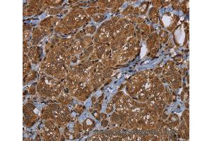 Immunohistochemistry of Human thyroid cancer using HSD17B4 Polyclonal Antibody at dilution of 1:30 (HSD17B4 抗体)