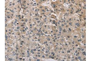 The image on the left is immunohistochemistry of paraffin-embedded Human liver cancer tissue using ABIN7129403(ESRRG Antibody) at dilution 1/30, on the right is treated with fusion protein. (ESRRG 抗体)