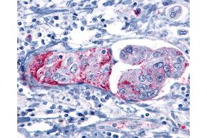 Anti-GRM8 / MGLUR8 antibody IHC of human Pancreas, Carcinoma. (GRM8 抗体  (C-Term))