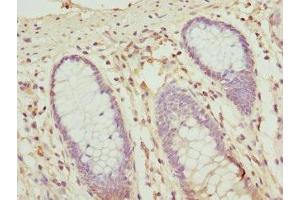 Immunohistochemistry of paraffin-embedded human colon cancer using ABIN7162209 at dilution of 1:100 (Oligophrenin 1 抗体  (AA 1-270))