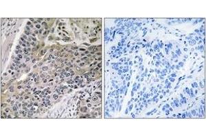 Immunohistochemistry analysis of paraffin-embedded human lung carcinoma tissue, using MRPS7 Antibody. (MRPS7 抗体  (AA 91-140))