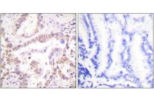 Immunohistochemistry analysis of paraffin-embedded human lung carcinoma tissue, using SKP2/p45 Antibody. (SKP2 抗体  (AA 366-415))