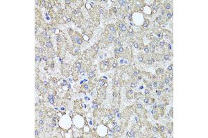 Immunohistochemistry of paraffin-embedded human liver injury using MUC16 antibody at dilution of 1:100 (x40 lens). (MUC16 抗体)