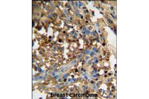 DMP4 antibody immunohistochemistry analysis in formalin fixed and paraffin embedded human breast carcinoma followed by peroxidase conjugation of the secondary antibody and DAB staining. (FAM20C 抗体  (C-Term))