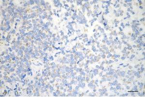 Immunohistochemistry was performed on paraffin-embedded human breast carcinoma using HDHD5 antibody (ABIN7798836), 1:200). (Recombinant Haloacid Dehalogenase-Like Hydrolase Domain-Containing 5 (HDHD5) 抗体)