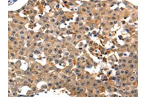The image on the left is immunohistochemistry of paraffin-embedded Human breast cancer tissue using ABIN7190883(GRM1 Antibody) at dilution 1/15, on the right is treated with synthetic peptide. (Metabotropic Glutamate Receptor 1 抗体)