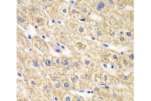 Immunohistochemistry of paraffin-embedded Human liver damage using ACADS Polyclonal Antibody at dilution of 1:100 (40x lens). (ACADS 抗体)