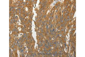 Immunohistochemistry of Human ovarian cancer using RPLP0 Polyclonal Antibody at dilution of 1:40 (RPLP0 抗体)