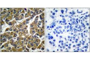 Immunohistochemistry analysis of paraffin-embedded human breast carcinoma tissue, using MMP-3 Antibody. (MMP3 抗体  (AA 421-470))