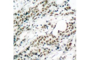 Immunohistochemistry of paraffin-embedded human breast carcinoma tissue, using Phospho-FOXO4-S197 antibody (ABIN2987524). (FOXO4 抗体  (pSer197))