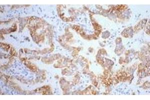 Immunohistochemistry of paraffin-embedded Human lung cancer tissue using CK-7 Monoclonal Antibody at dilution of 1:200. (Cytokeratin 7 抗体)