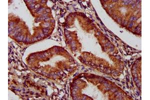 IHC image of ABIN7160839 diluted at 1:500 and staining in paraffin-embedded human endometrial cancer performed on a Leica BondTM system. (NADK2 抗体  (AA 16-156))