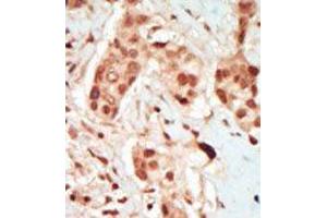 Formalin-fixed and paraffin-embedded human cancer tissue reacted with the primary antibody, which was peroxidase-conjugated to the secondary antibody, followed by DAB staining. (Cyclin-Dependent Kinase 15 (ALS2CR7) (N-Term) 抗体)