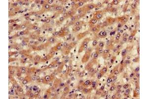 Immunohistochemistry of paraffin-embedded human liver cancer using ABIN7145235 at dilution of 1:100 (BBS1 抗体  (AA 435-552))