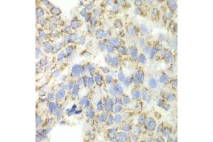 Immunohistochemistry of paraffin-embedded human esophageal cancer using ALDH4A1 antibody at dilution of 1:100 (x40 lens). (ALDH4A1 抗体)