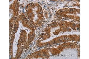 Immunohistochemistry of Human esophagus cancer using CSH1 Polyclonal Antibody at dilution of 1:40 (CSH1 抗体)
