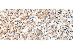 Immunohistochemistry of paraffin-embedded Human ovarian cancer tissue using S100A16 Polyclonal Antibody at dilution of 1:25(x200) (S100A16 抗体)